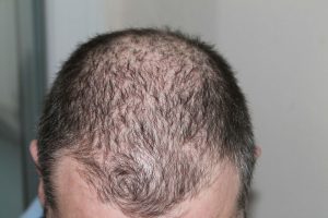 implants cheveux