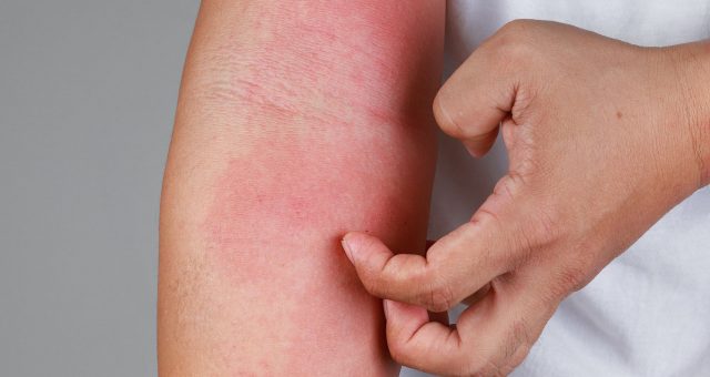 Les différents types d’eczéma