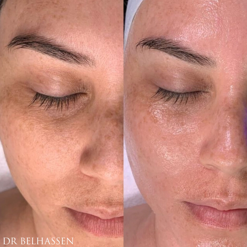 Avant/ après le soin Hydrafacial